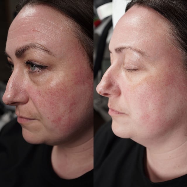 Threadvein and broken capillaries removed for much less redness 