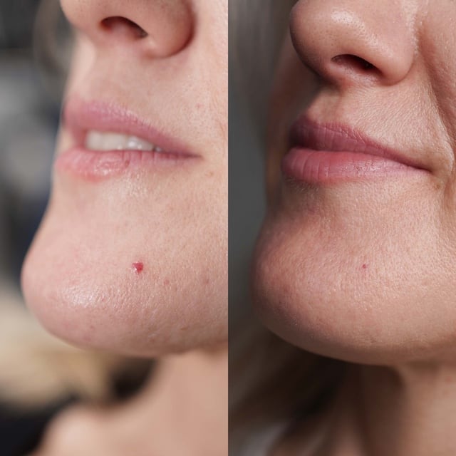 Cherry angioma removal from chin with laser treatment.