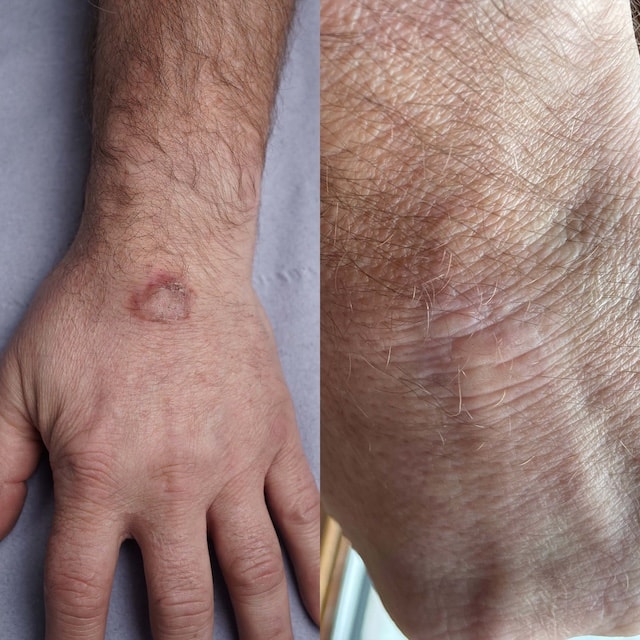 Laser wart removal result on hand after failed cryotherapy and topical treatments