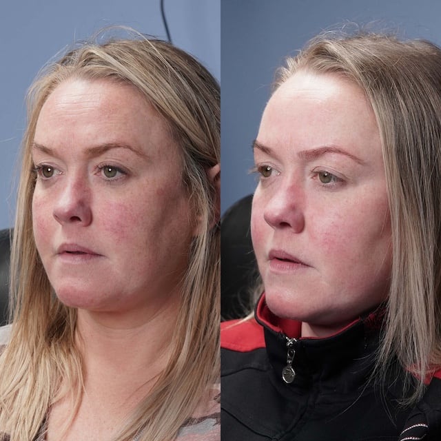 Full face vein removal to reduce facial redness