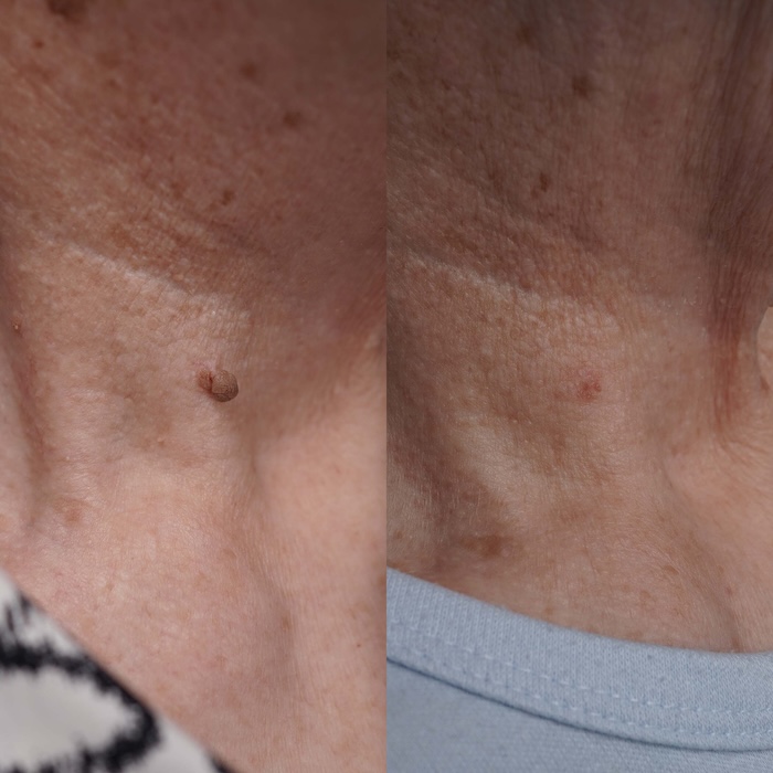 Laser removal of skin tag from neck area with early healing showing slight hyperpigmentation.