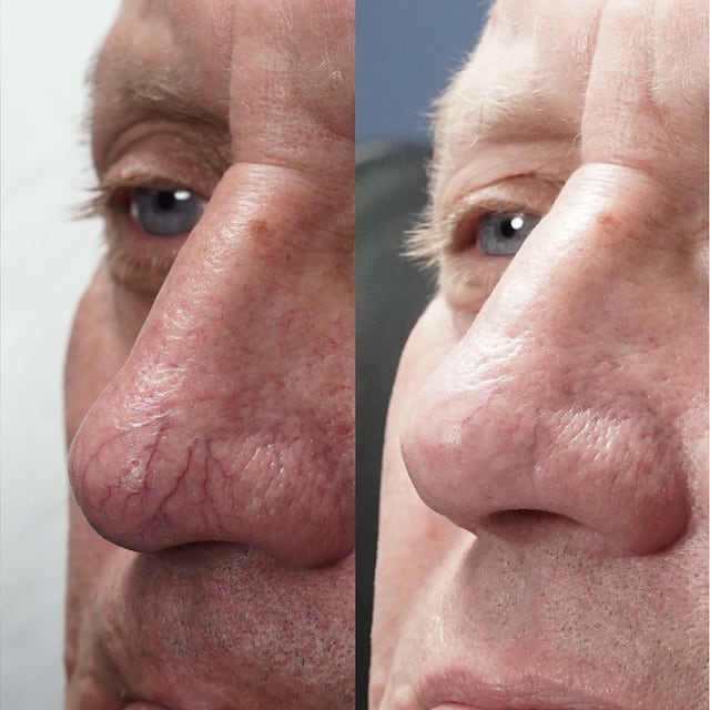 Large nose veins removed with laser