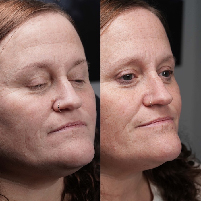 Before and after image showing two small nose fibromas removed in a single laser treatment, leaving clear skin with no visible scarring.