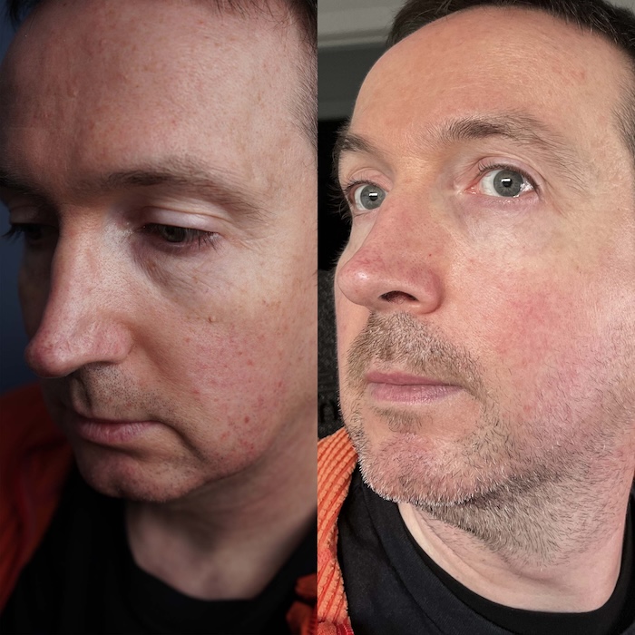 Male client before and after single-session laser removal of a facial fibroma with flawless result