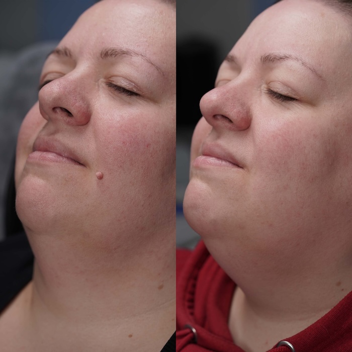 Before and after skin tag removal from chin area, with flawless skin after healing