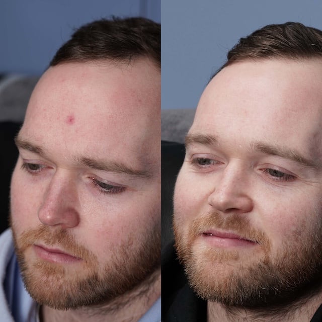 Spider angioma removal from forehead, clear skin after treatment.