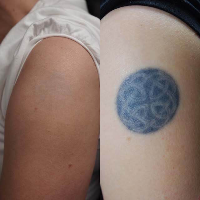 Tattoo removal before and after