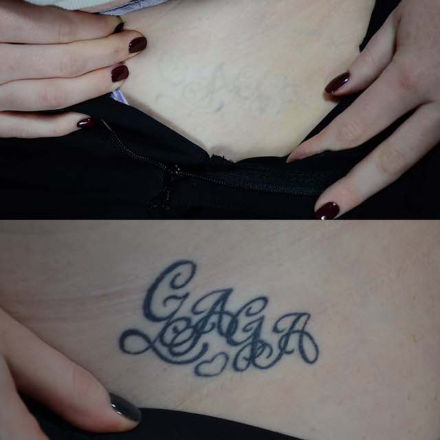 Tattoo removal before and after