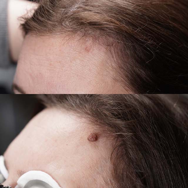 Skintag removal before and after