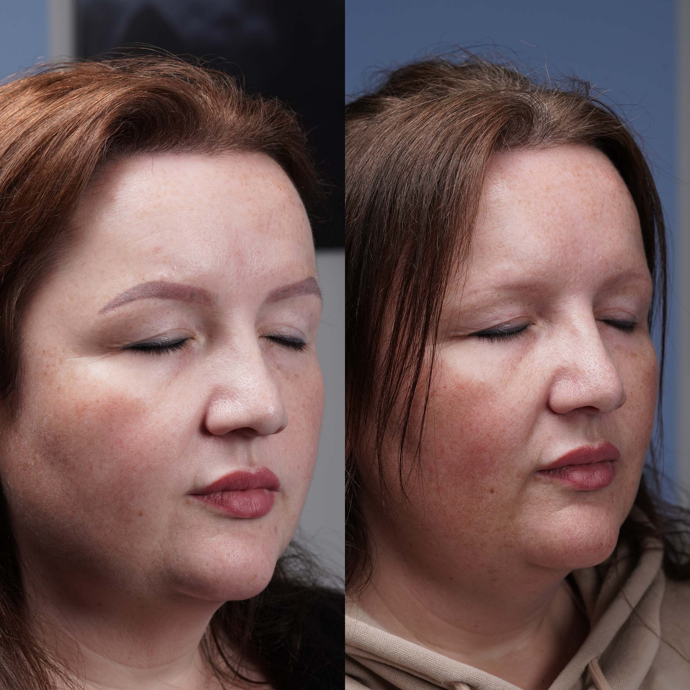 tattoo removal before and after