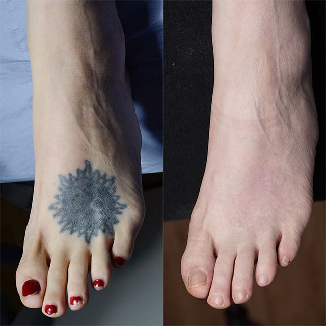 Sun tattoo removal before and after