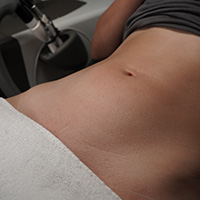 Hair Removal thumbnail