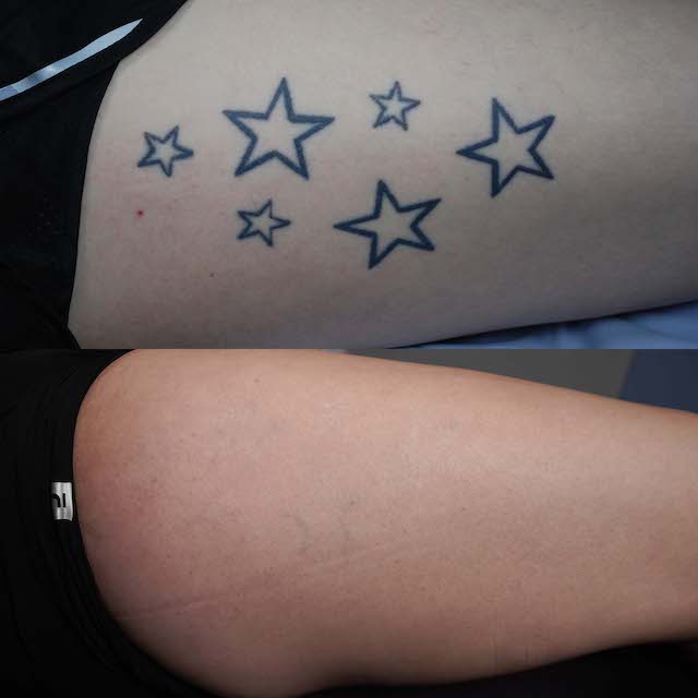 tattoo removal before and after