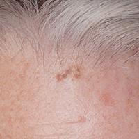 Pigmentation removal thumbnail