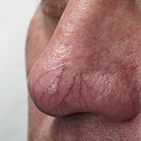 Vein removal thumbnail